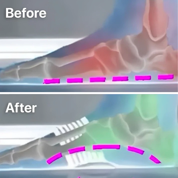 StepRelief™ | Orthopädische Fußgewölbestütze [1+1 Gratis]